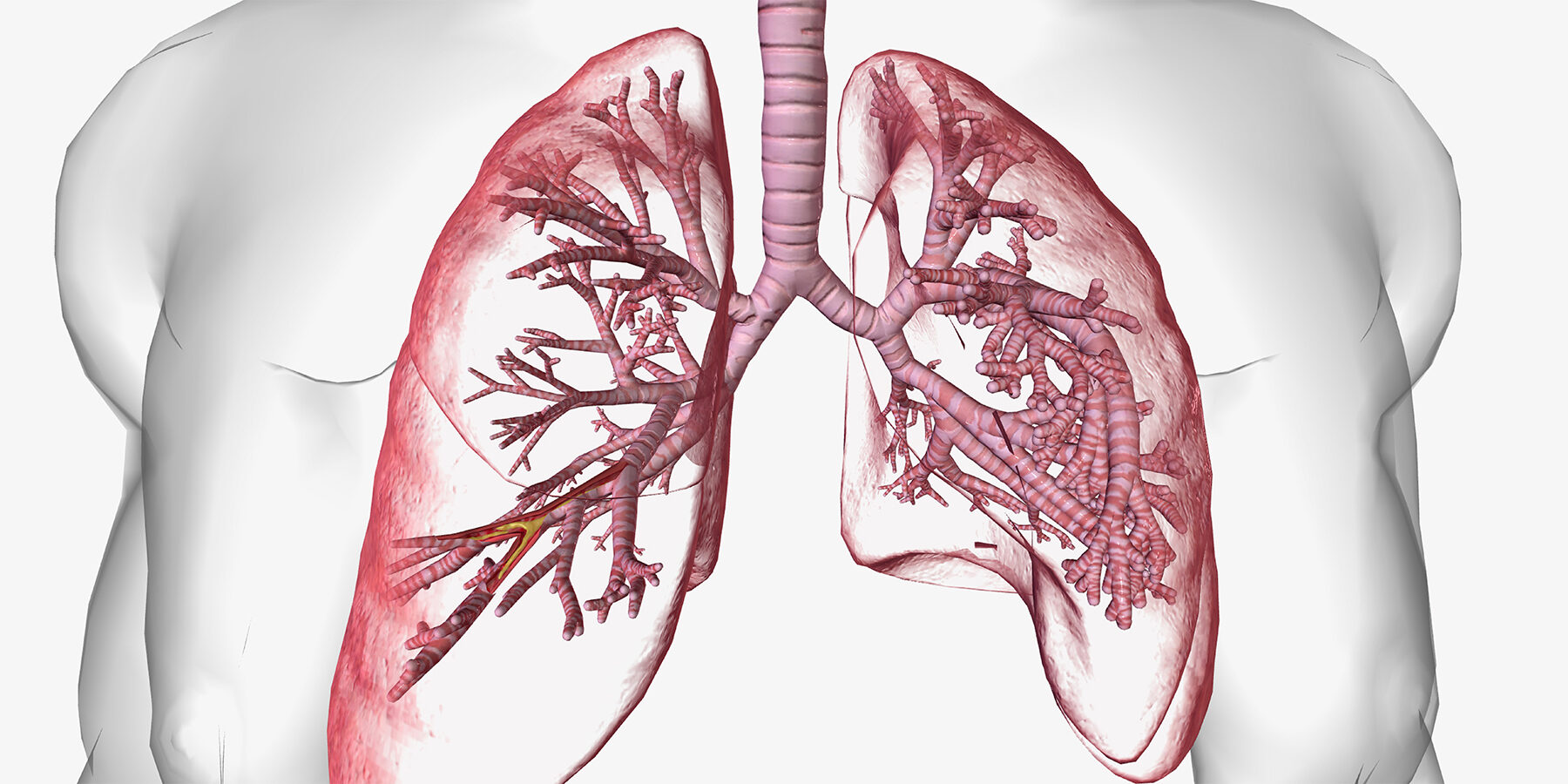imagem mostrando dilatação dos brônquios em paciente com bronquiectasia.