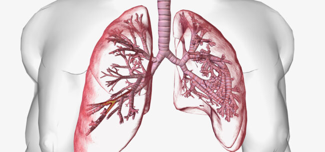 imagem mostrando dilatação dos brônquios em paciente com bronquiectasia.