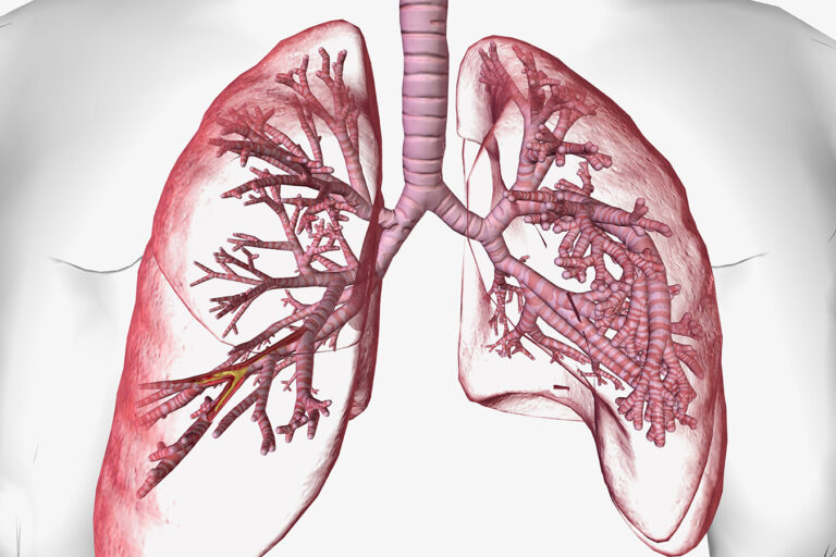 imagem mostrando dilatação dos brônquios em paciente com bronquiectasia.